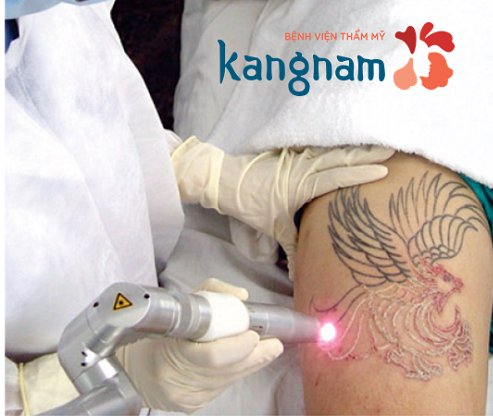 Xóa xăm an toàn và nhanh chóng với Laser Toning Plus xóa hình xăm bằng Laser Toning