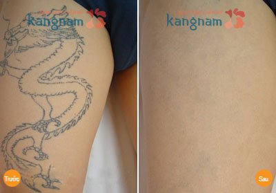 xóa xăm vùng kín không để lại sẹo