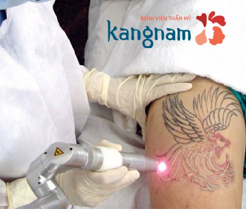 xóa xăm vùng kín bằng Laser toning