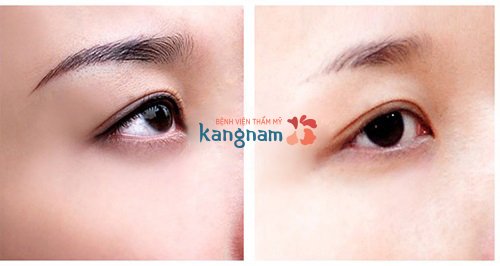 Mình rất hài lòng về kết quả sau khi xóa xăm mí mắt tại Kangnam kết quả sau khi xóa xăm mí mắt tại Kangnam