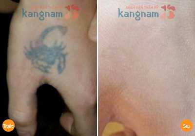 Xóa hình xăm có đau không 1