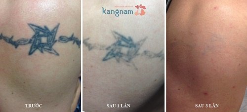 xóa hình xăm ở tay 3