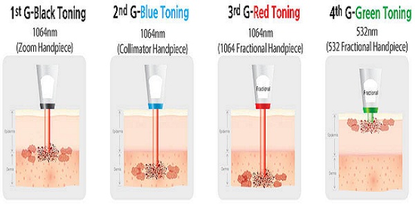 Xóa xăm bằng Laser hiệu quả đến không ngờ