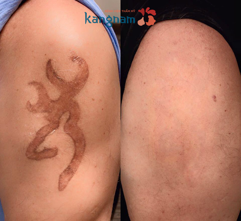 Xóa hình xăm ở đâu tốt nhất hiện nay? – Tiêu chí đánh giá