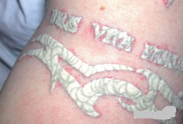 Tại sao lại có hiện tượng đóng vảy sau xóa xăm?