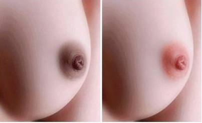 Có cách nào xóa xăm nhũ hoa không?