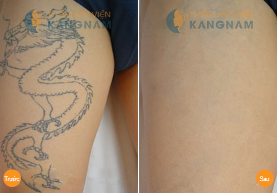 Phương pháp xóa xăm nào đạt hiệu quả cao nhất sau thực hiện