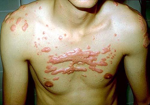 Rùng mình với những phương pháp xóa hình xăm thủ công