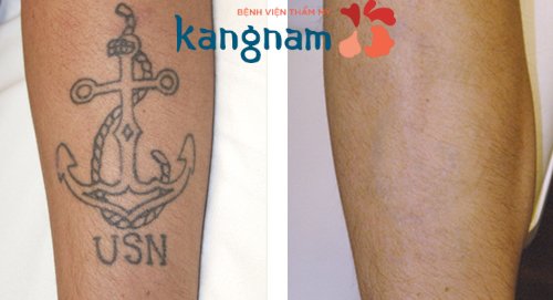 Thẩm mỹ viện xóa hình xăm thẩm mỹ