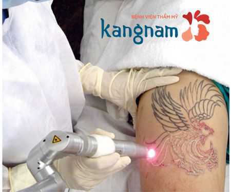 Xóa hình xăm có hết không mọi người