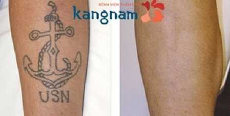 Laser Toning xóa hình xăm có hết không?