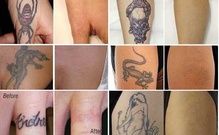 Công nghệ Laser Toning xóa hình xăm có hết không?