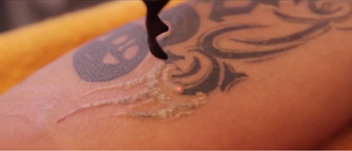 Xóa xăm lông mày bằng Laser Toning Plus có để lại sẹo không?